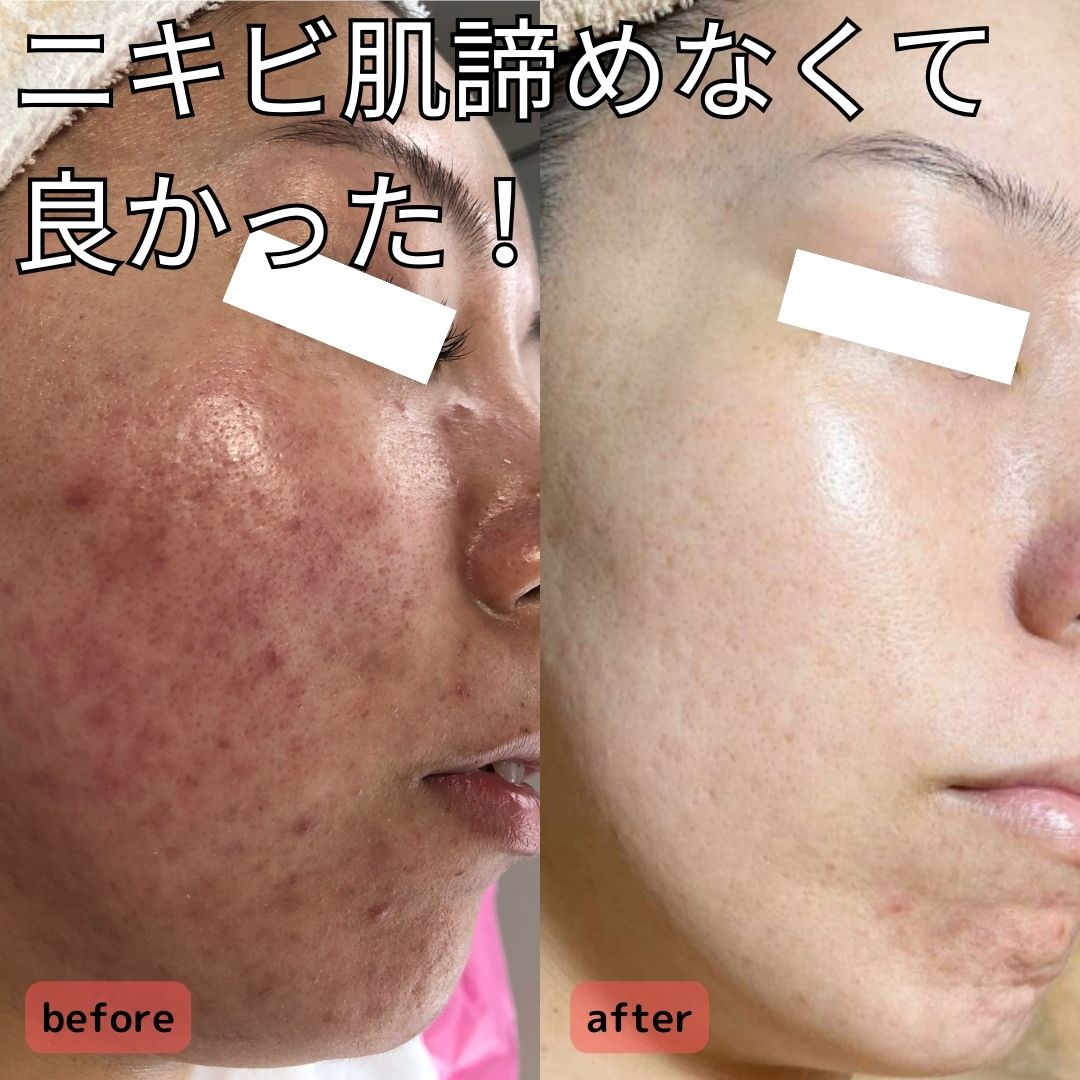 ニキビ肌さんにはこれ！オイルフリークリームとは？/Perfect for Acne: Oil-Free Cream!